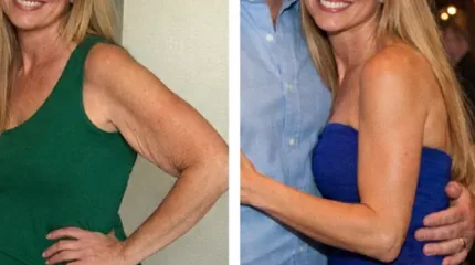 Before and after photos shared by a MyoGlow customer showing her upper arm